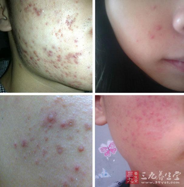 免疫力低下得皮肤病 什么原因导致皮肤病