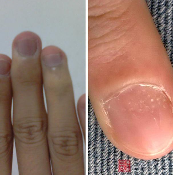 如果一个人的整个指甲都像是毛玻璃一样