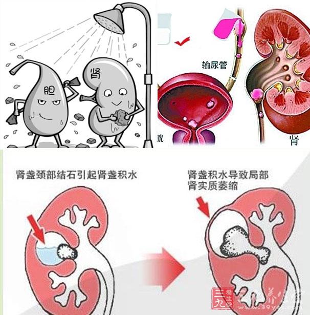 肾积水的病因 什么问题导致了肾积水