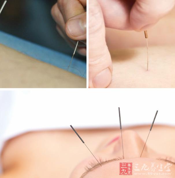 针灸治疗高血脂症