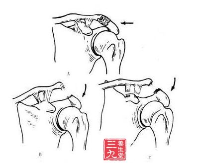 单侧关节突关节脱位
