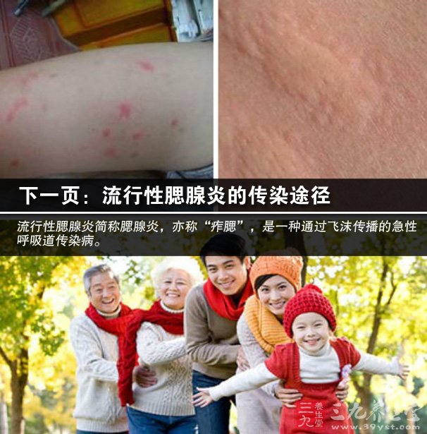 流行性腮腺炎疫苗多少_疫苗炎流行性腮腺炎怎么办_流行性腮腺炎疫苗接种