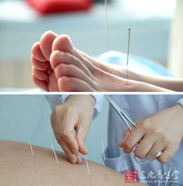 中医针灸 针灸竟可以美容祛斑